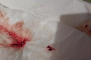 1.怀孕出血的常见原因
